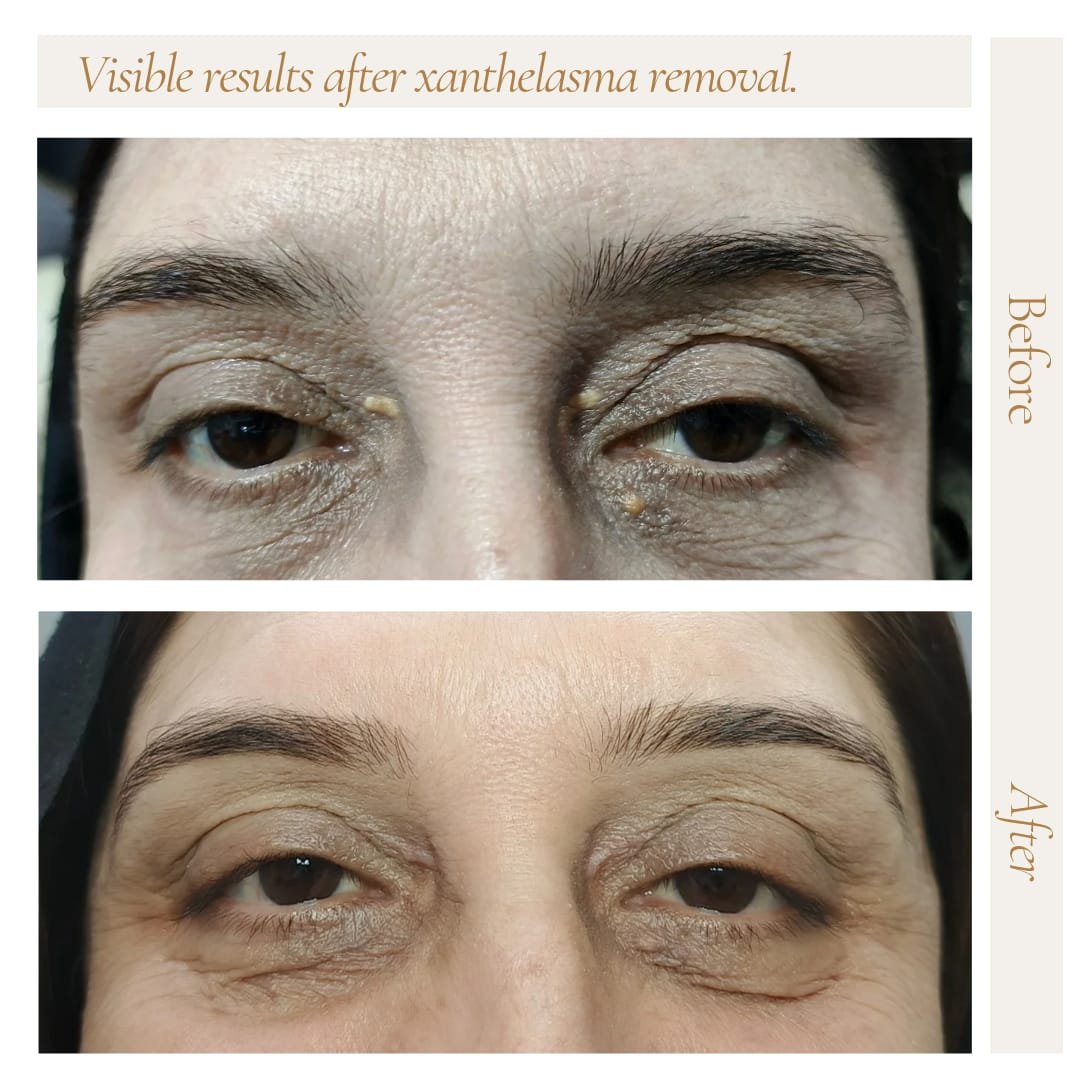 Before and after xanthelasma removal