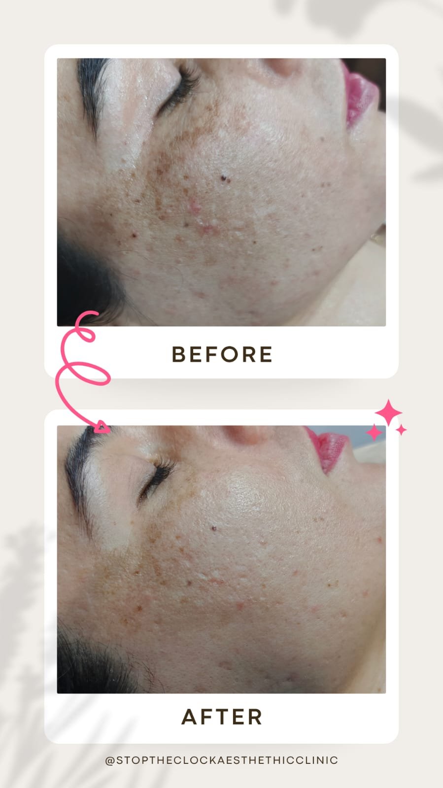 Before and after melasma treatment