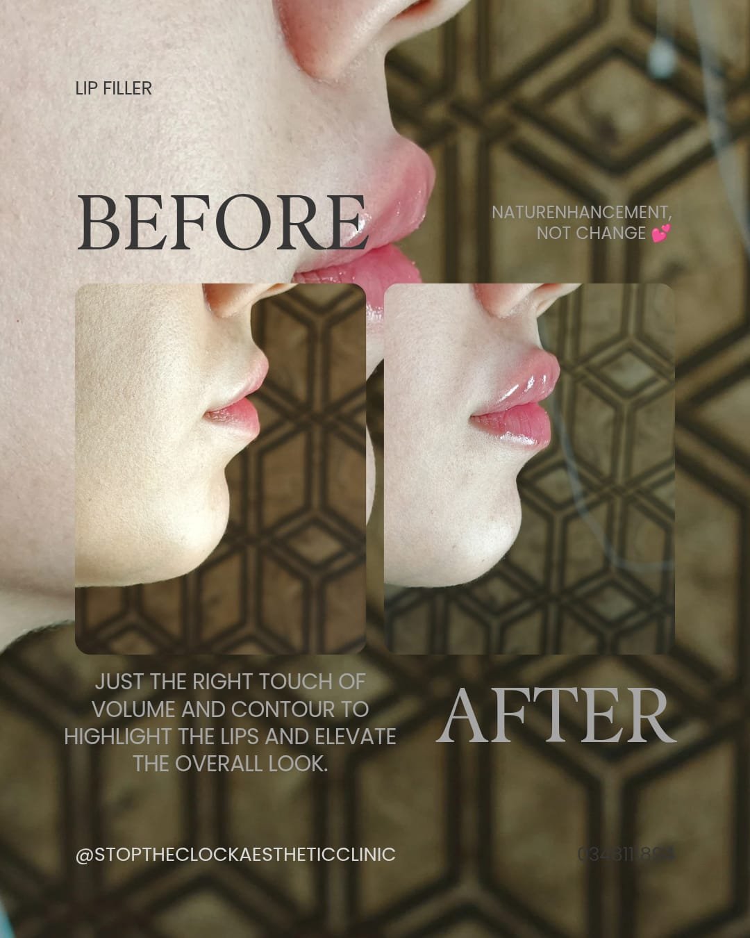 Before and after lip filler profile view