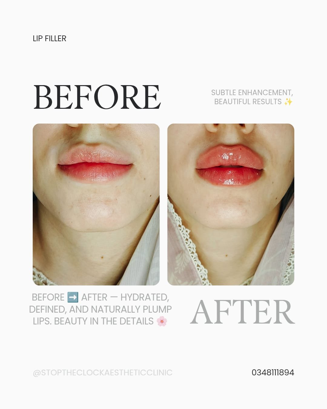Before and after lip filler front view