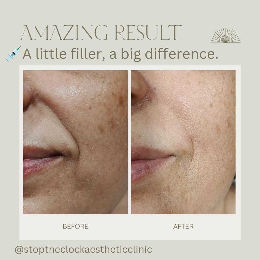 Before and after botox treatment