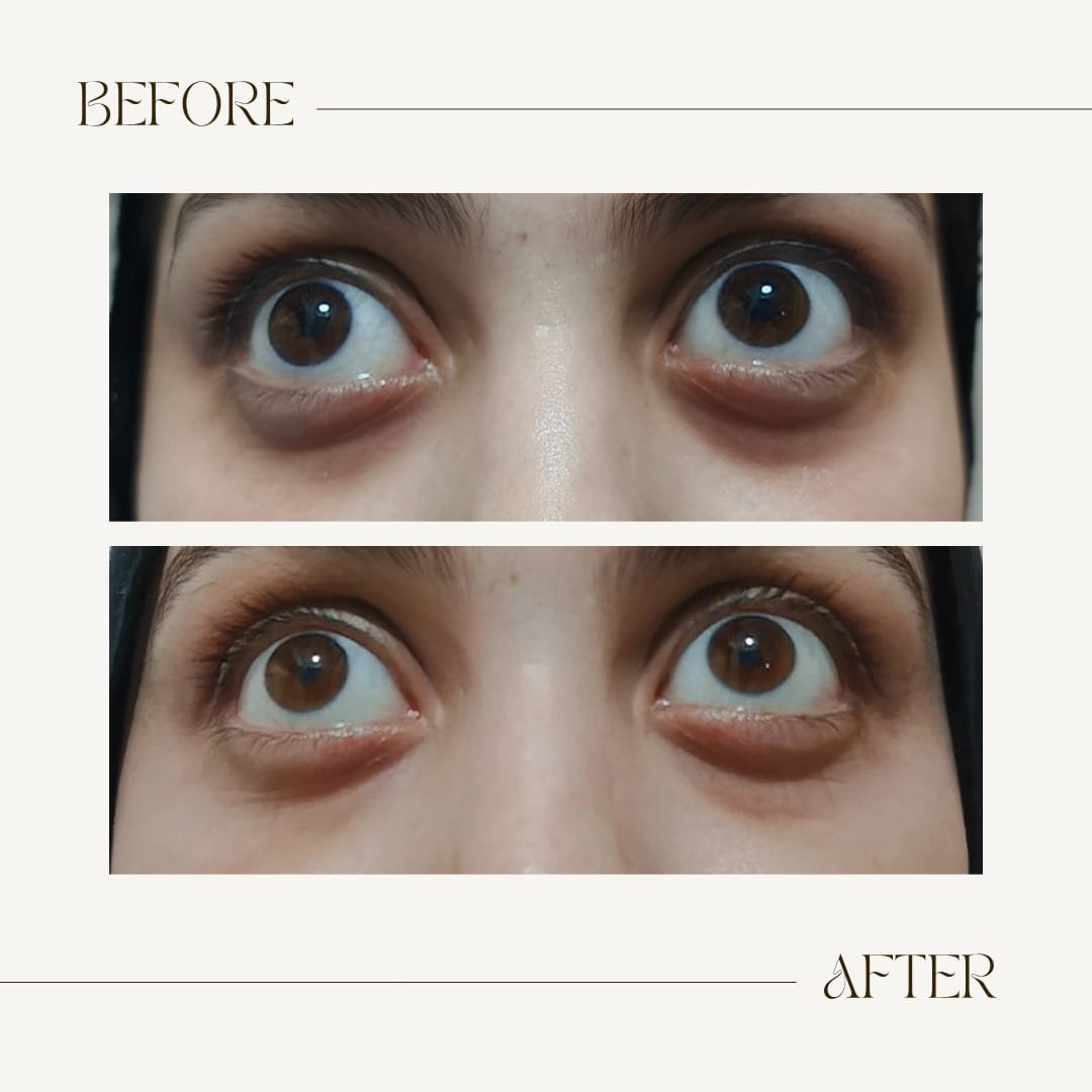 Before and after dark circle treatment